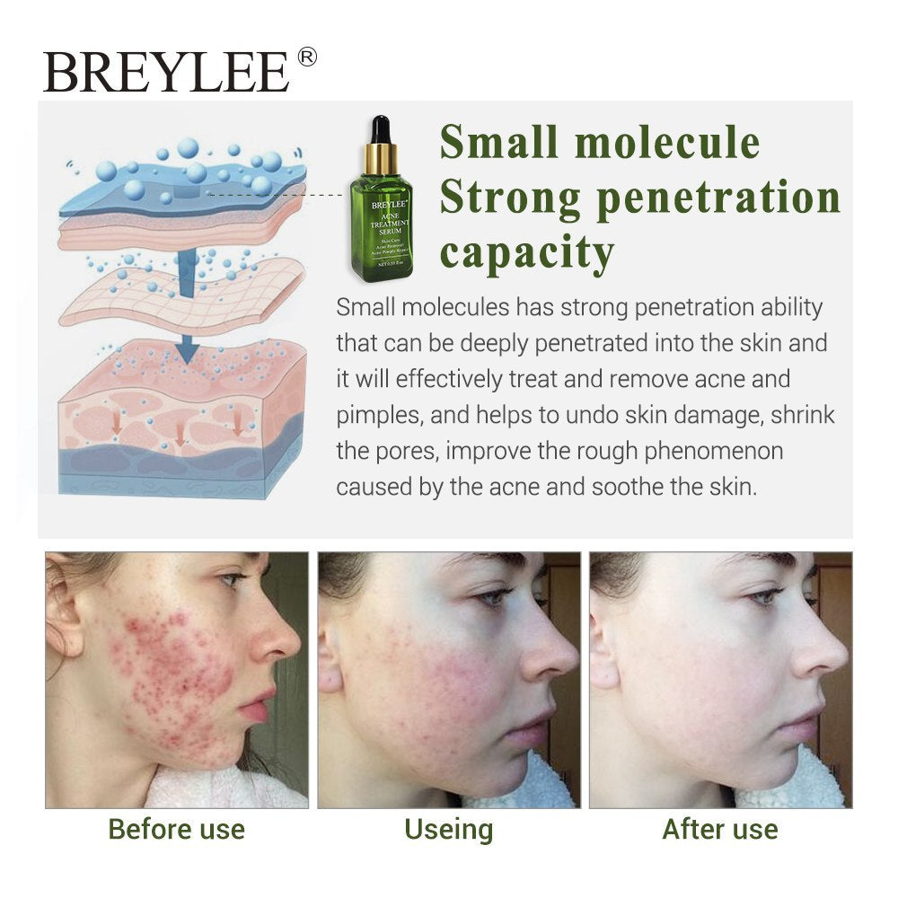 BREYLEE Acne Treatment Serum